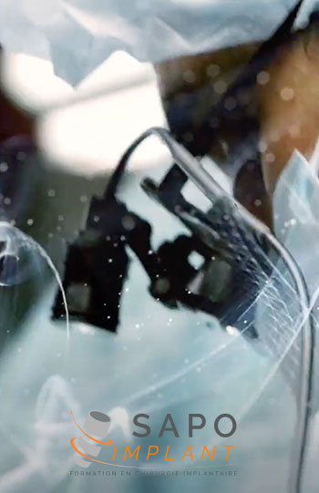 Sapo Implant – Greffes osseuses et sinus lift